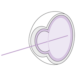 Cataract_development_step_1