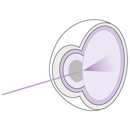 Cataract_development_step_2