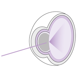 Cataract_development_step_3