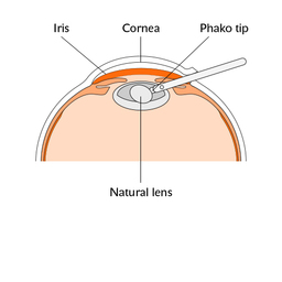 Refractive_lens_procedure_diagram_slide