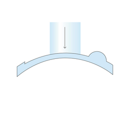 Lasek_procedure_diagram_slide3